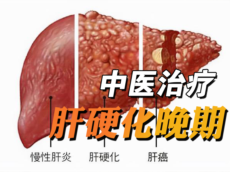 中医治疗肝硬化晚期